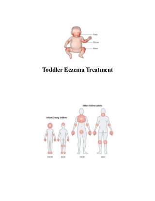 Toddler Eczema Treatment
 