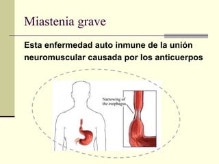 Miastenia grave
Esta enfermedad auto inmune de la unión
neuromuscular causada por los anticuerpos
 