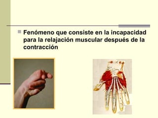  Fenómeno que consiste en la incapacidad
para la relajación muscular después de la
contracción
 