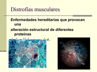 Distrofias musculares
Enfermedades hereditarias que provocan
una
alteración estructural de diferentes
proteínas
de la célula muscular.
 