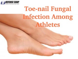 Toe­nail Fungal 
Infection Among 
Athletes
 