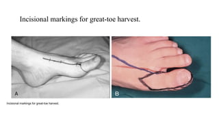 Incisional markings for great-toe harvest.
A
 