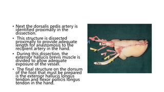 • Next the dorsalis pedis artery is
identified proximally in the
dissection.
• This structure is dissected
proximally to provide adequate
length for anastomosis to the
recipient artery in the hand.
• During this dissection, the
extensor hallucis brevis muscle is
divided to allow adequate
exposure of the vessel.
• The final structure on the dorsum
of the foot that must be prepared
is the extensor hallucis longus
tendon and flexor pollicis longus
tendon in the hand.
 