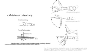 • Metatarsal osteotomy
 