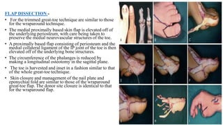 FLAP DISSECTION -
• For the trimmed great-toe technique are similar to those
for the wraparound technique.
• The medial proximally based skin flap is elevated off of
the underlying periosteum, with care being taken to
preserve the medial neurovascular structures of the toe.
• A proximally based flap consisting of periosteum and the
medial collateral ligament of the IP joint of the toe is then
elevated off of the underlying bone structures.
• The circumference of the phalanges is reduced by
making a longitudinal osteotomy in the sagittal plane.
• The toe is harvested and inset in a fashion similar to that
of the whole great-toe technique.
• Skin closure and management of the nail plate and
eponychial fold are similar to those of the wraparound
great-toe flap. The donor site closure is identical to that
for the wraparound flap.
 