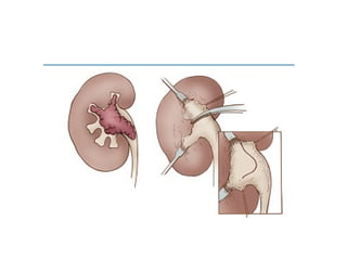 EXTENDED PYELONEPHROLITHOTOMY | PPT