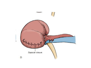 EXTENDED PYELONEPHROLITHOTOMY | PPT