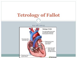 2 5 - 0 8 - 2 0 1 5
Tetrology of Fallot
 
