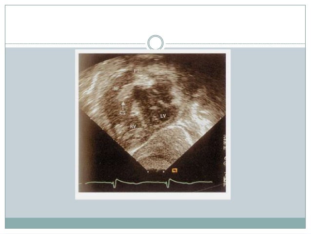 term papers on tetrology of fallot Surgical managemant of tetralogy of fallot dj brockman, bvsc, cvr, csao long-term palliation of tetralogy of fallot in dogs by use of a modified blalock. term papers on tetrology of fallot Surgical managemant of tetralogy of fallot dj brockman, bvsc, cvr, csao long-term palliation of tetralogy of fallot in dogs by use of a modified blalock.