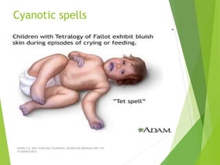 Cyanotic spells
JERIN.T.S, 3RD YEAR BSC NURSING, KRSMCON MANGALORE. PH:
+919496743672
 