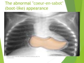 The abnormal "coeur-en-sabot"
(boot-like) appearance
JERIN.T.S, 3RD YEAR BSC NURSING, KRSMCON MANGALORE. PH:
+919496743672
 