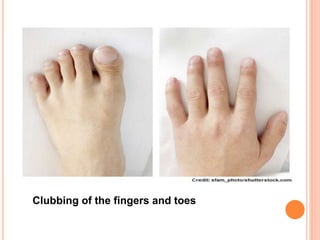 Clubbing of the fingers and toes
 