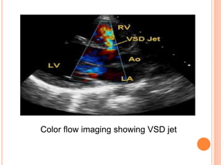 Color flow imaging showing VSD jet
 