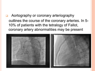  Aortography or coronary arteriography
outlines the course of the coronary arteries. In 5-
10% of patients with the tetralogy of Fallot,
coronary artery abnormalities may be present
 