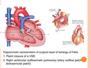 Diagrammatic representation of surgical repair of tetralogy of Fallot.
1. Patch closure of a VSD
2. Right ventricular outflow/main pulmonary artery outflow patch
(transannular patch)
 