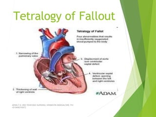 Tetralogy of Fallout
JERIN.T.S, 3RD YEAR BSC NURSING, KRSMCON MANGALORE. PH:
+919496743672
 