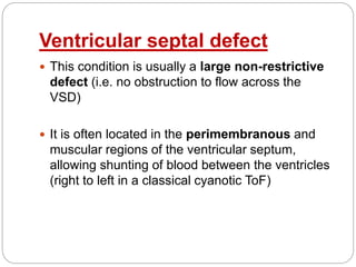 Ventricular septal defect
 This condition is usually a large non-restrictive
defect (i.e. no obstruction to flow across the
VSD)
 It is often located in the perimembranous and
muscular regions of the ventricular septum,
allowing shunting of blood between the ventricles
(right to left in a classical cyanotic ToF)
 