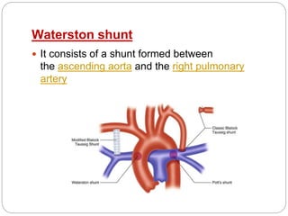 Waterston shunt
 It consists of a shunt formed between
the ascending aorta and the right pulmonary
artery
 