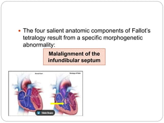 The four salient anatomic components of Fallot’s
tetralogy result from a specific morphogenetic
abnormality:
Malalignment of the
infundibular septum
 