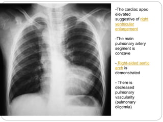 -The cardiac apex
elevated
suggestive of right
ventricular
enlargement
-The main
pulmonary artery
segment is
concave
- Right-sided aortic
arch is
demonstrated
- There is
decreased
pulmonary
vascularity
(pulmonary
oligemia)
 