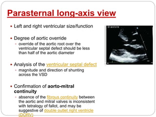 Parasternal long-axis view
 Left and right ventricular size/function
 Degree of aortic override
 override of the aortic root over the
ventricular septal defect should be less
than half of the aortic diameter
 Analysis of the ventricular septal defect
 magnitude and direction of shunting
across the VSD
 Confirmation of aorto-mitral
continuity
 absence of the fibrous continuity between
the aortic and mitral valves is inconsistent
with tetralogy of fallot, and may be
suggestive of double outlet right ventricle
(DORV)
 