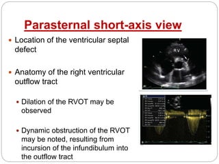 Parasternal short-axis view
 Location of the ventricular septal
defect
 Anatomy of the right ventricular
outflow tract
 Dilation of the RVOT may be
observed
 Dynamic obstruction of the RVOT
may be noted, resulting from
incursion of the infundibulum into
the outflow tract
 