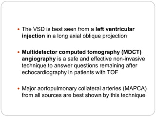  The VSD is best seen from a left ventricular
injection in a long axial oblique projection
 Multidetector computed tomography (MDCT)
angiography is a safe and effective non-invasive
technique to answer questions remaining after
echocardiography in patients with TOF
 Major aortopulmonary collateral arteries (MAPCA)
from all sources are best shown by this technique
 