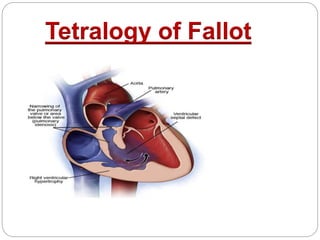 Tetralogy of Fallot
 