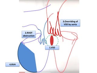 1.VSD
2.RVOT
obstruction
3.Overriding of
VSD by aorta
4.RVH
 