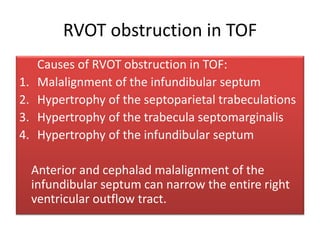 RVOT obstruction in TOF
Causes of RVOT obstruction in TOF:
1. Malalignment of the infundibular septum
2. Hypertrophy of the septoparietal trabeculations
3. Hypertrophy of the trabecula septomarginalis
4. Hypertrophy of the infundibular septum
Anterior and cephalad malalignment of the
infundibular septum can narrow the entire right
ventricular outflow tract.
 