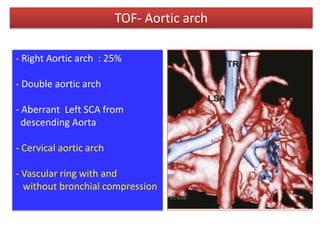 TOF- Aortic arch
- Right Aortic arch : 25%
- Double aortic arch
- Aberrant Left SCA from
descending Aorta
- Cervical aortic arch
- Vascular ring with and
without bronchial compression
 
