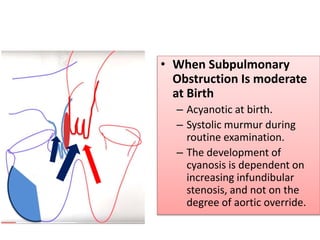• When Subpulmonary
Obstruction Is moderate
at Birth
– Acyanotic at birth.
– Systolic murmur during
routine examination.
– The development of
cyanosis is dependent on
increasing infundibular
stenosis, and not on the
degree of aortic override.
 