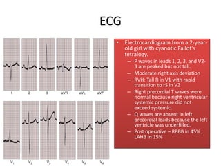 ECG
• Electrocardiogram from a 2-year-
old girl with cyanotic Fallot’s
tetralogy.
– P waves in leads 1, 2, 3, and V2-
3 are peaked but not tall.
– Moderate right axis deviation
– RVH: Tall R in V1 with rapid
transition to rS in V2
– Right precordial T waves were
normal because right ventricular
systemic pressure did not
exceed systemic.
– Q waves are absent in left
precordial leads because the left
ventricle was underfilled.
– Post operative – RBBB in 45% ,
LAHB in 15%
 