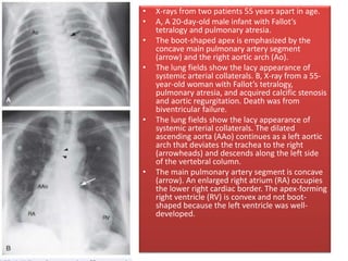 • X-rays from two patients 55 years apart in age.
• A, A 20-day-old male infant with Fallot’s
tetralogy and pulmonary atresia.
• The boot-shaped apex is emphasized by the
concave main pulmonary artery segment
(arrow) and the right aortic arch (Ao).
• The lung fields show the lacy appearance of
systemic arterial collaterals. B, X-ray from a 55-
year-old woman with Fallot’s tetralogy,
pulmonary atresia, and acquired calcific stenosis
and aortic regurgitation. Death was from
biventricular failure.
• The lung fields show the lacy appearance of
systemic arterial collaterals. The dilated
ascending aorta (AAo) continues as a left aortic
arch that deviates the trachea to the right
(arrowheads) and descends along the left side
of the vertebral column.
• The main pulmonary artery segment is concave
(arrow). An enlarged right atrium (RA) occupies
the lower right cardiac border. The apex-forming
right ventricle (RV) is convex and not boot-
shaped because the left ventricle was well-
developed.
 