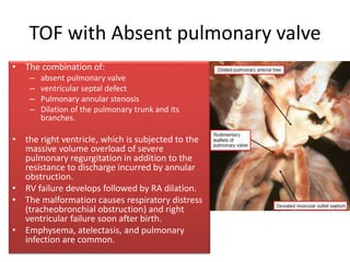 TOF with Absent pulmonary valve
• The combination of:
– absent pulmonary valve
– ventricular septal defect
– Pulmonary annular stenosis
– Dilation of the pulmonary trunk and its
branches.
• the right ventricle, which is subjected to the
massive volume overload of severe
pulmonary regurgitation in addition to the
resistance to discharge incurred by annular
obstruction.
• RV failure develops followed by RA dilation.
• The malformation causes respiratory distress
(tracheobronchial obstruction) and right
ventricular failure soon after birth.
• Emphysema, atelectasis, and pulmonary
infection are common.
 