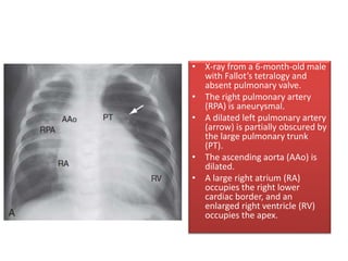 • X-ray from a 6-month-old male
with Fallot’s tetralogy and
absent pulmonary valve.
• The right pulmonary artery
(RPA) is aneurysmal.
• A dilated left pulmonary artery
(arrow) is partially obscured by
the large pulmonary trunk
(PT).
• The ascending aorta (AAo) is
dilated.
• A large right atrium (RA)
occupies the right lower
cardiac border, and an
enlarged right ventricle (RV)
occupies the apex.
 