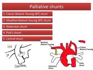 Palliative shunts
1. Classic Blalock-Taussig (BT) shunt
2. Modified Blalock-Taussig (BT) shunt
3. Waterston shunt
4. Pott’s shunt
5. Central shunt
 