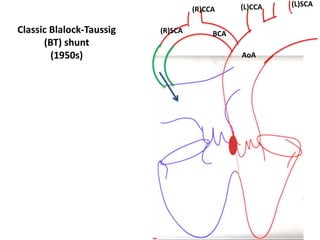 AoA
(L)CCA (L)SCA
(R)SCA
(R)CCA
BCA
Classic Blalock-Taussig
(BT) shunt
(1950s)
 