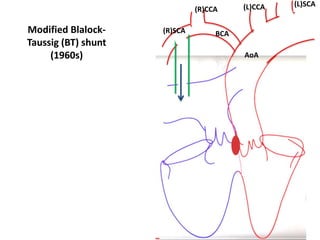 AoA
(L)CCA (L)SCA
(R)SCA
(R)CCA
BCA
Modified Blalock-
Taussig (BT) shunt
(1960s)
 