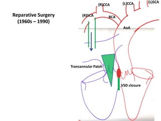 AoA
(L)CCA (L)SCA
(R)SCA
(R)CCA
BCA
Reparative Surgery
(1960s – 1990)
Transannular Patch
VSD closure
 