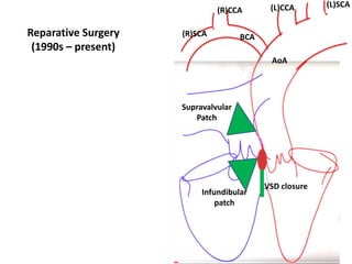AoA
(L)CCA (L)SCA
(R)SCA
(R)CCA
BCA
Reparative Surgery
(1990s – present)
VSD closure
Supravalvular
Patch
Infundibular
patch
 