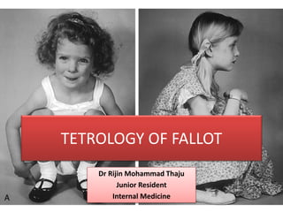 TETROLOGY OF FALLOT
Dr Rijin Mohammad Thaju
Junior Resident
Internal Medicine
 