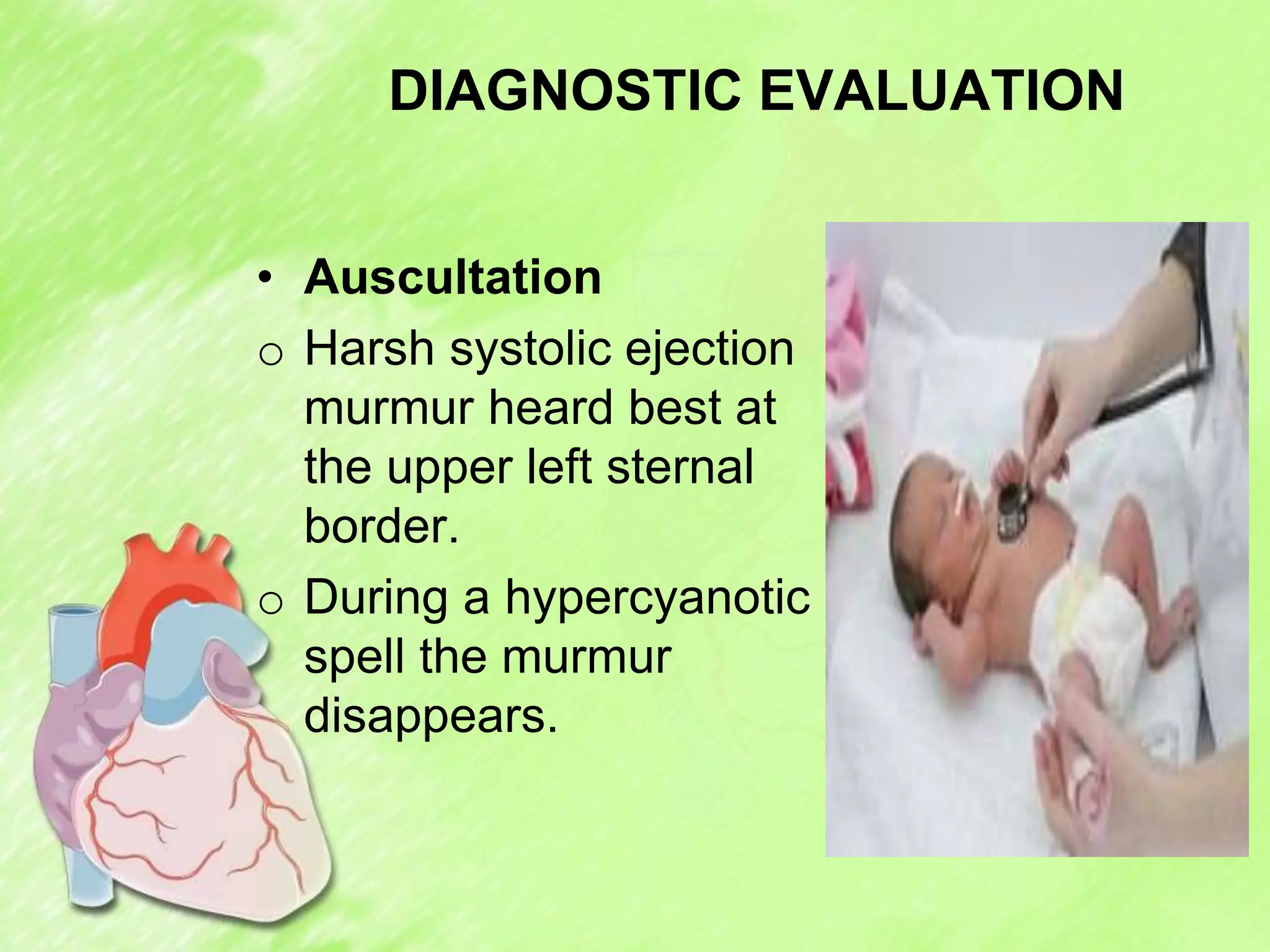 DIAGNOSTIC EVALUATION
• Auscultation
o Harsh systolic ejection
murmur heard best at
the upper left sternal
border.
o During a hypercyanotic
spell the murmur
disappears.
 
