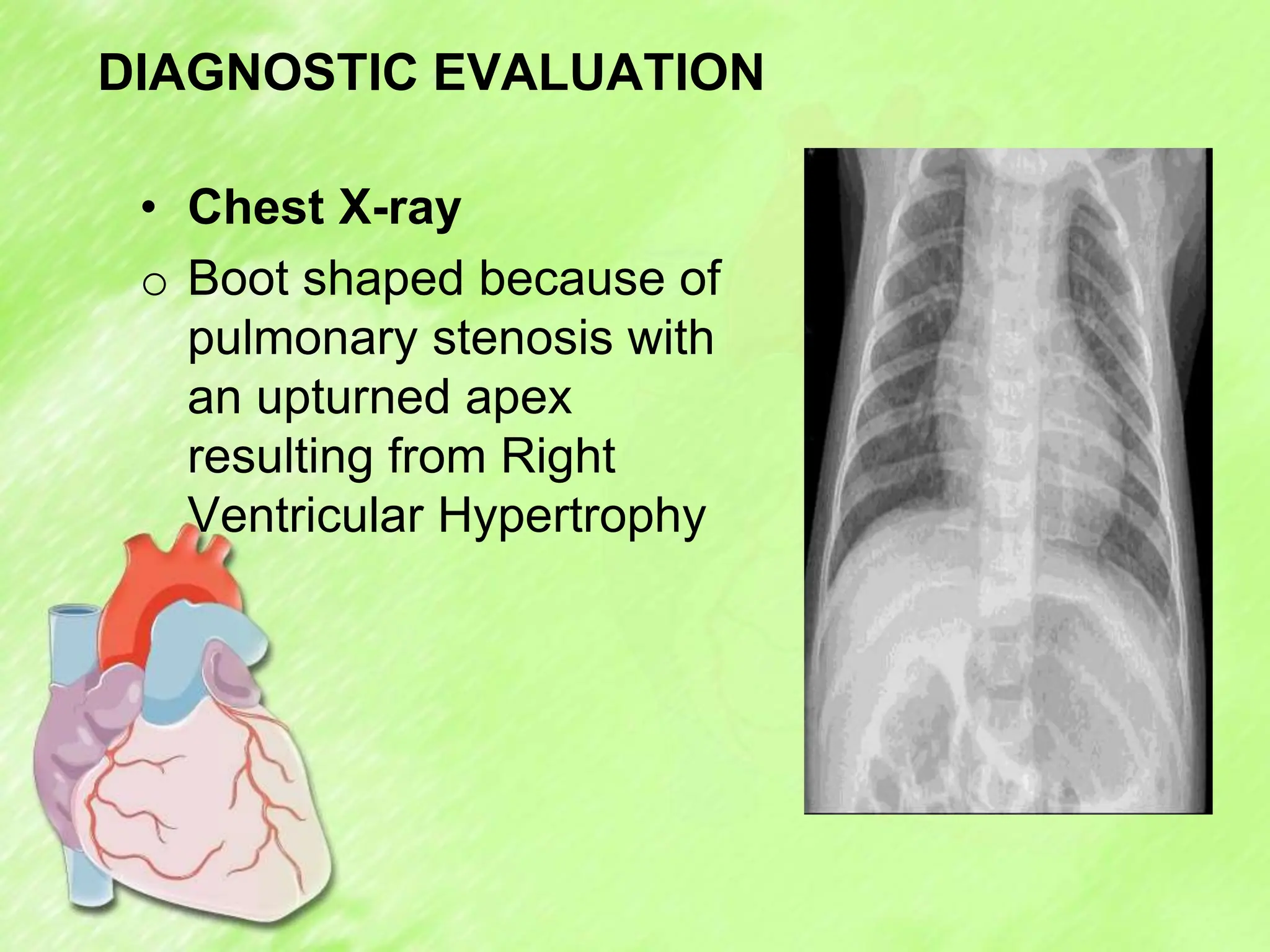 DIAGNOSTIC EVALUATION
• Chest X-ray
o Boot shaped because of
pulmonary stenosis with
an upturned apex
resulting from Right
Ventricular Hypertrophy
 