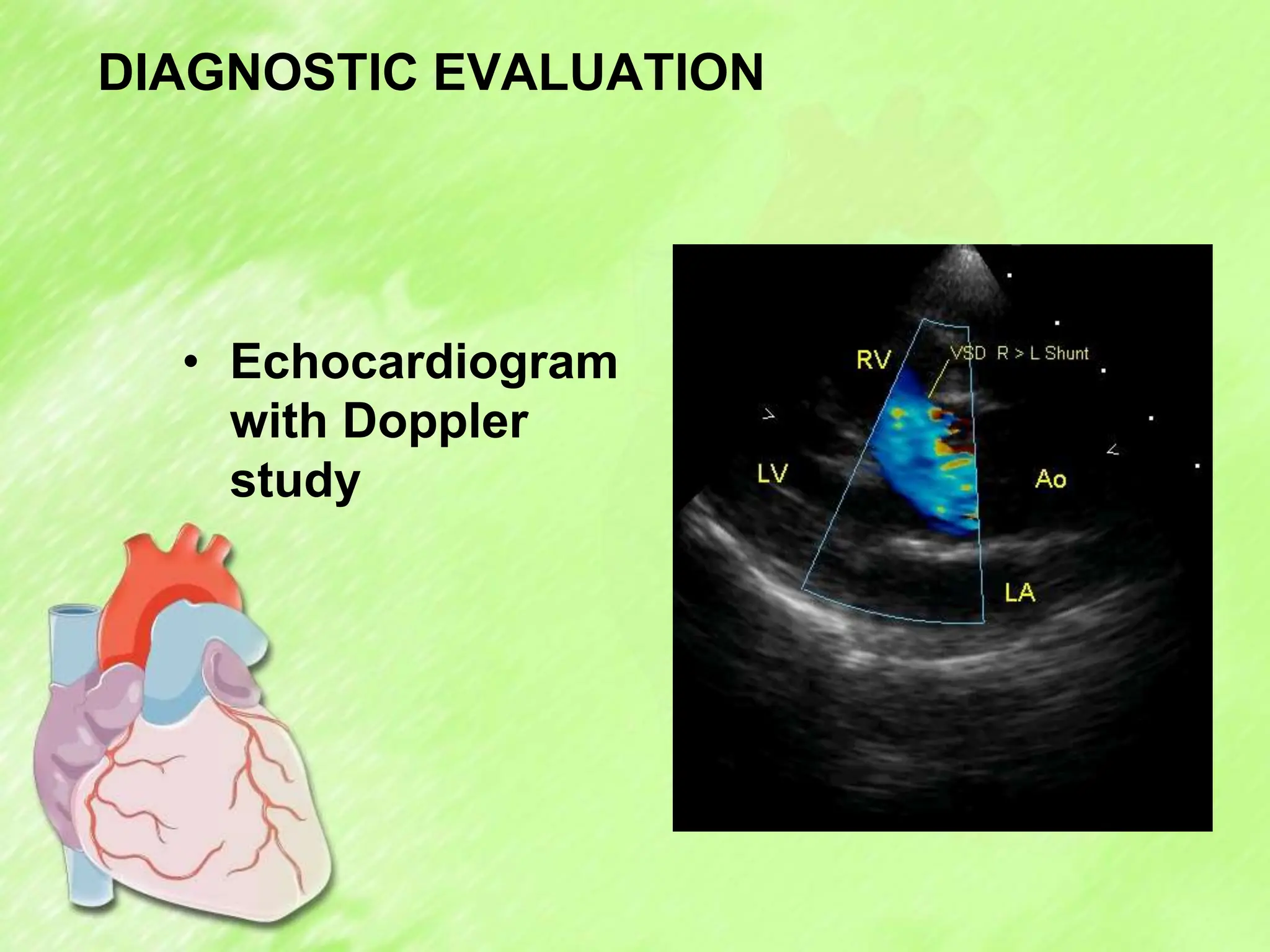 DIAGNOSTIC EVALUATION
• Echocardiogram
with Doppler
study
 