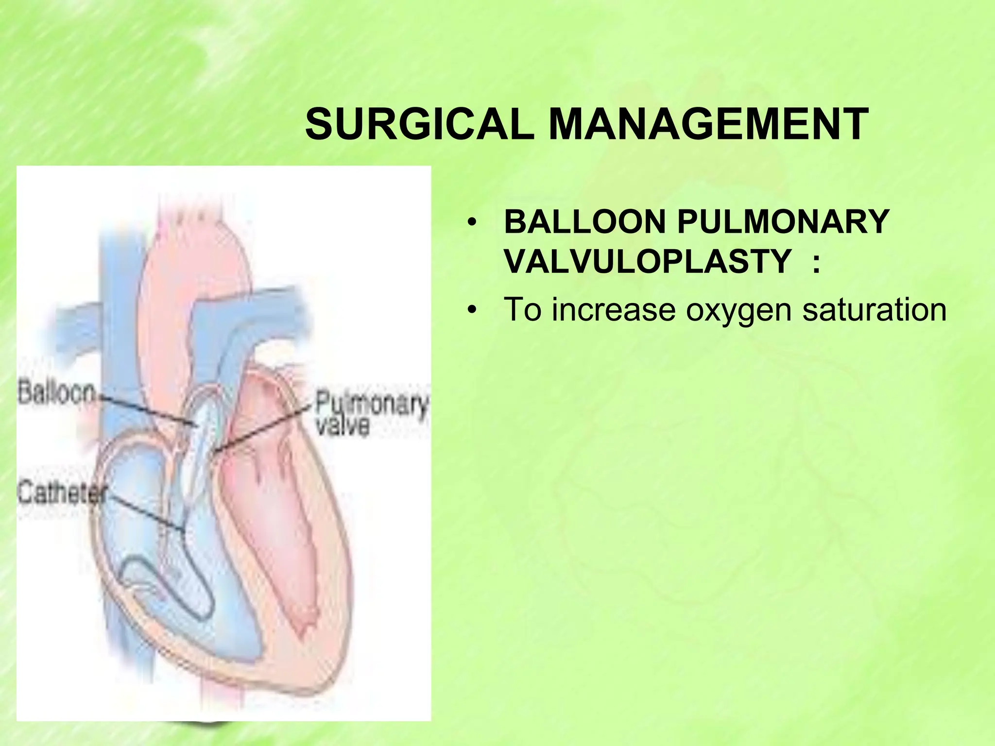 SURGICAL MANAGEMENT
• BALLOON PULMONARY
VALVULOPLASTY :
• To increase oxygen saturation
 