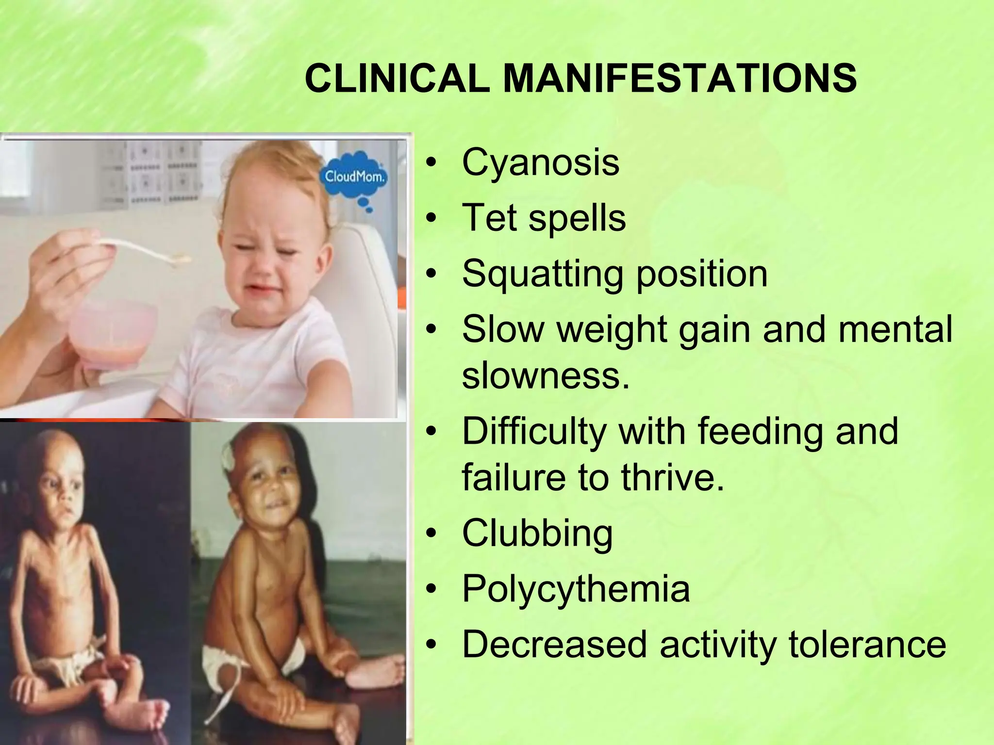 CLINICAL MANIFESTATIONS
• Cyanosis
• Tet spells
• Squatting position
• Slow weight gain and mental
slowness.
• Difficulty with feeding and
failure to thrive.
• Clubbing
• Polycythemia
• Decreased activity tolerance
 