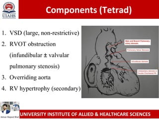 Comprehensive Overview of Tetralogy of Fallot: Congenital Heart Defect ...