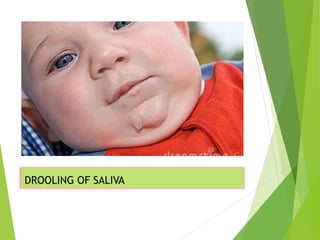 tracheo oesophagal fistula gihs | PPT