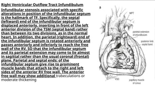 TOF BY DR POOJA anatomy tetralogy of fallot.pptx